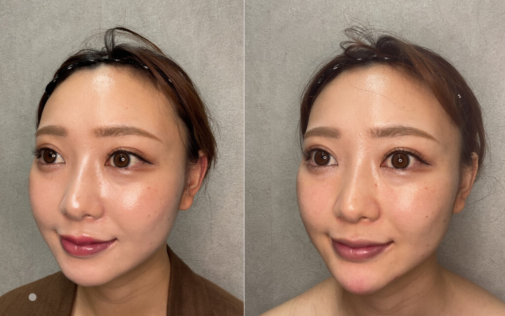 20代女性 顎ライン改善 Before/After 斜め