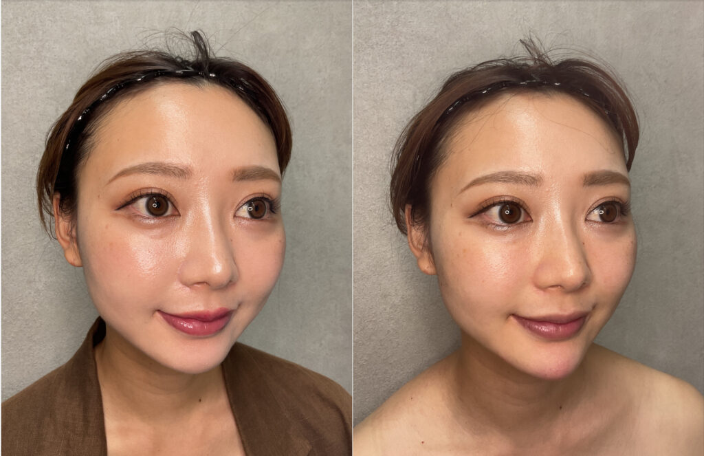 20代女性の顎ライン改善ビフォーアフター