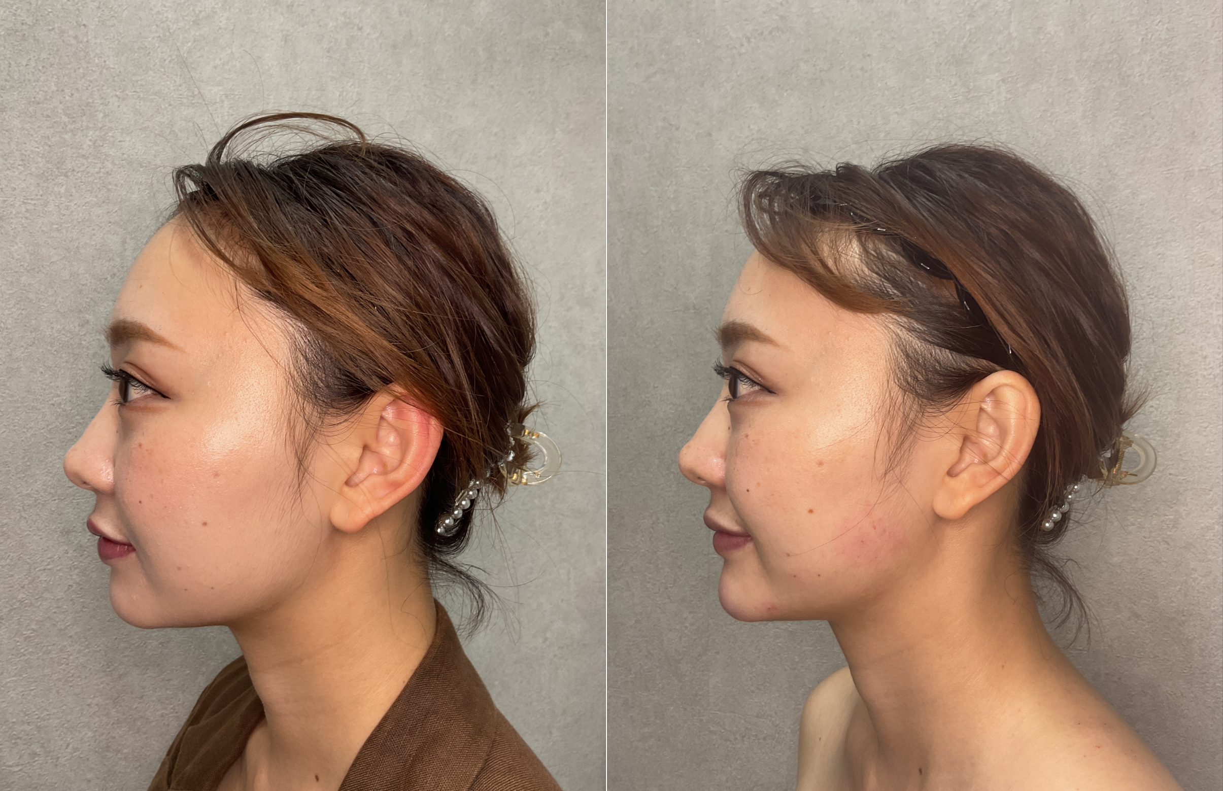 20代女性 顎ライン改善 Before/After 横顔｜大阪 心斎橋 BiBiクリニック ヒアルロン酸＋ボトックス