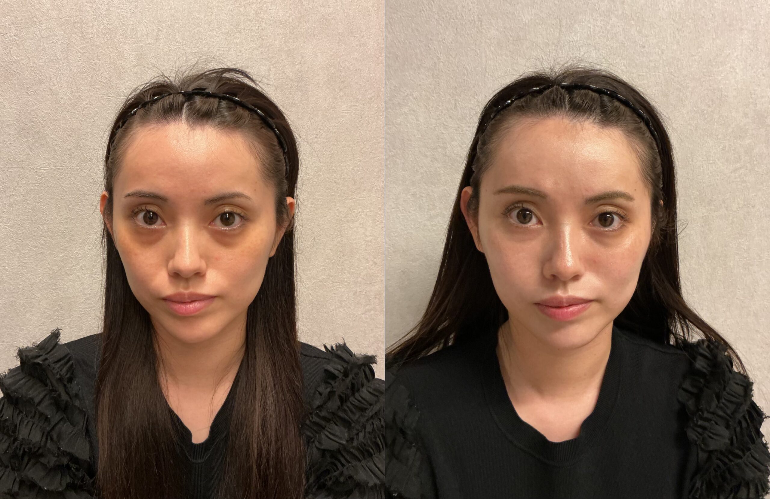 20代女性のクマ・頬のこけ改善【症例写真あり】｜ヒアルロン酸（ボリューマ）による自然なバランス調整の症例写真