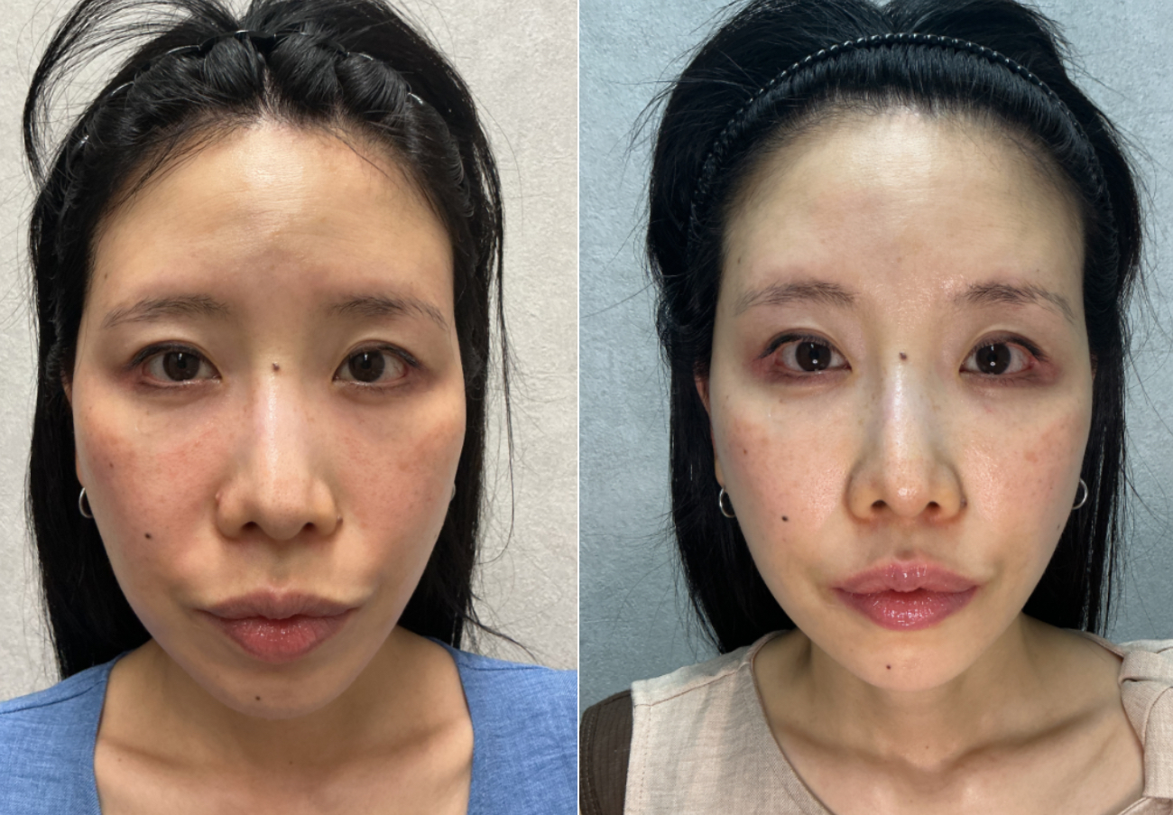 40代 女性 顔全体のたるみ 改善 正面 Before/After
