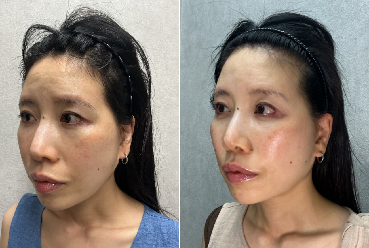 40代 女性 顔全体のたるみ 改善 右斜め Before/After