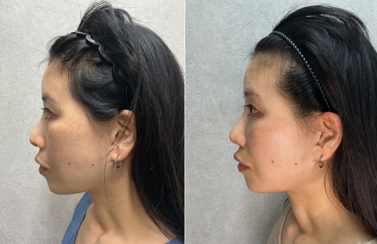 40代 女性 顔全体のたるみ 改善 右横 Before/After