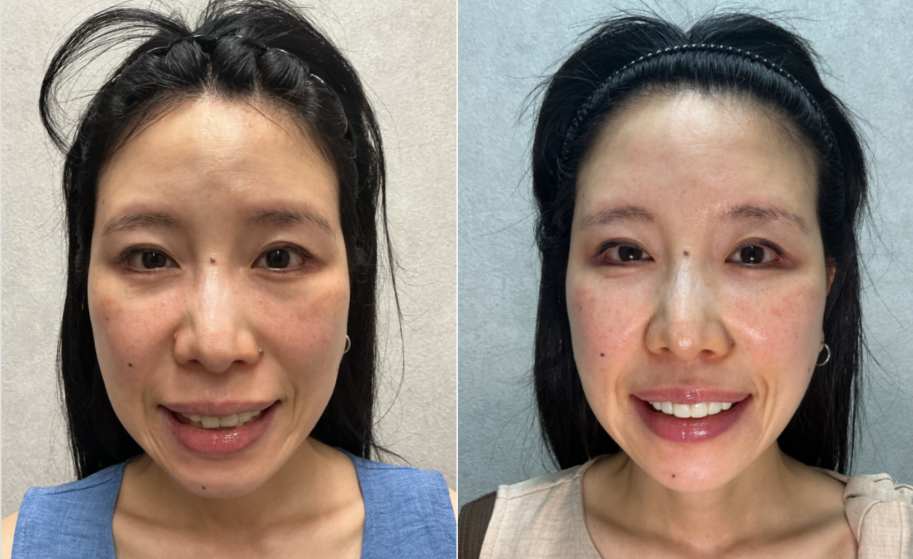 40代 女性 顔全体のたるみ 改善 正面笑顔 Before/After