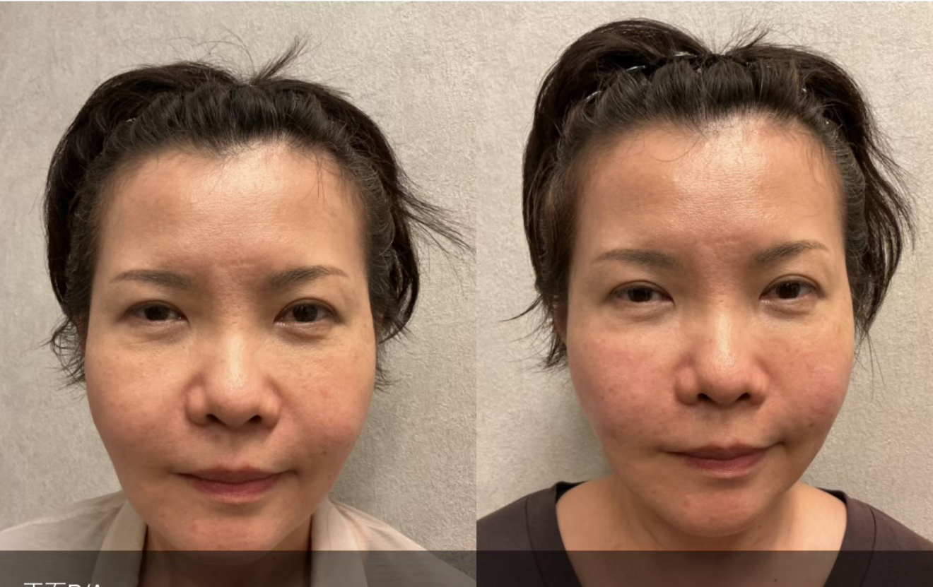 50代女性のほうれい線・フェイスライン改善｜ヒアルロン酸注入（ボリューマ3本）【症例写真あり】の症例写真