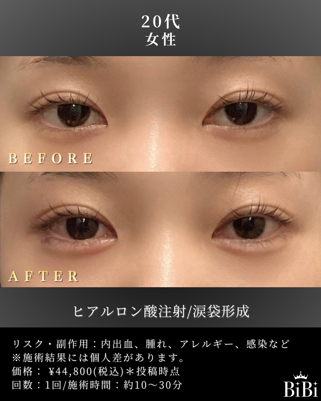 20代 涙袋ヒアルロン酸 症例写真〔正面Before/After〕｜大阪 心斎橋BiBiクリニック