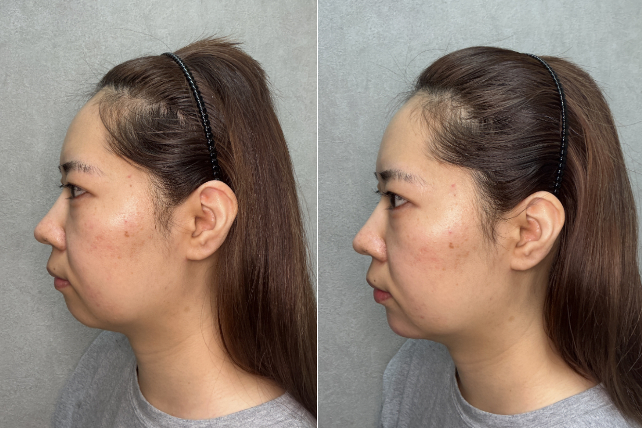 30代女性の顎ヒアルロン酸(ボラックス2本)｜大阪心斎橋BiBiクリニック症例の症例写真