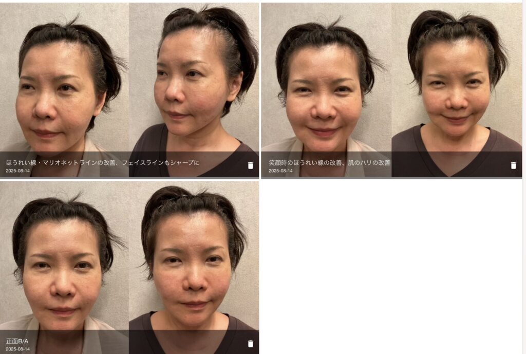 50代女性のほうれい線・フェイスライン改善ビフォーアフター