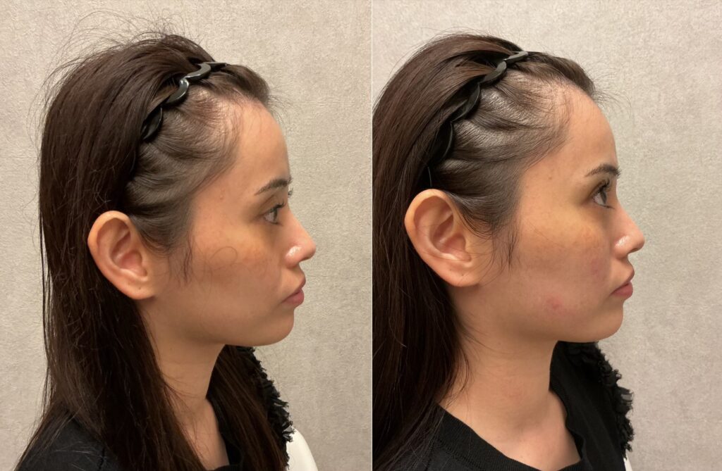 20代女性 くま、頬こけ、ほうれい線 アラガン社製ヒアルロン酸 ボリューマ3本