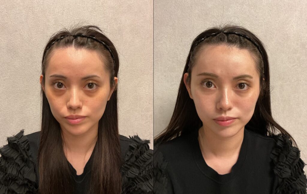 20代女性 くま、頬こけ、ほうれい線 アラガン社製ヒアルロン酸 ボリューマ3本