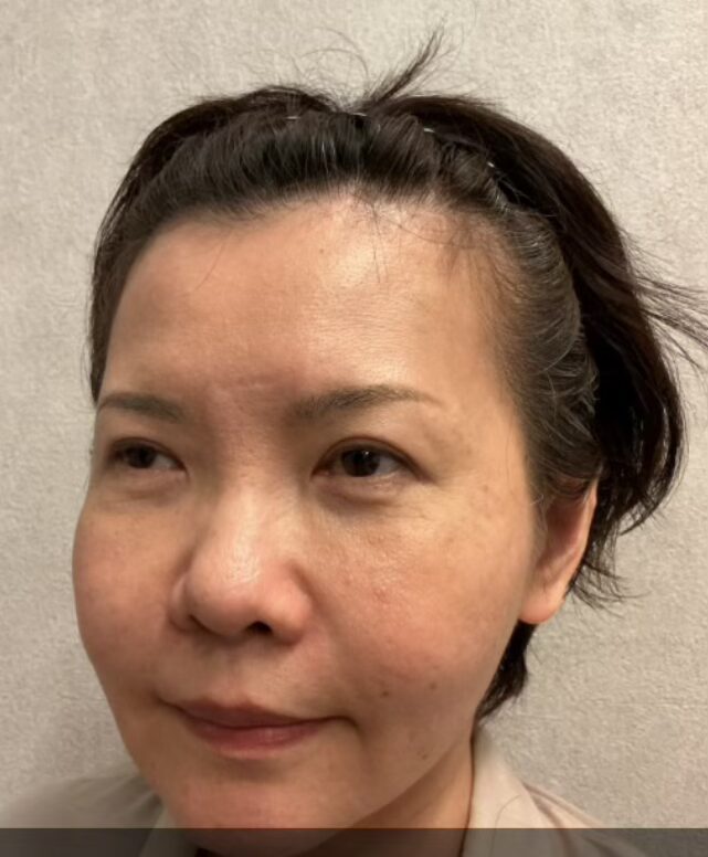50代女性のほうれい線・フェイスライン改善ビフォー