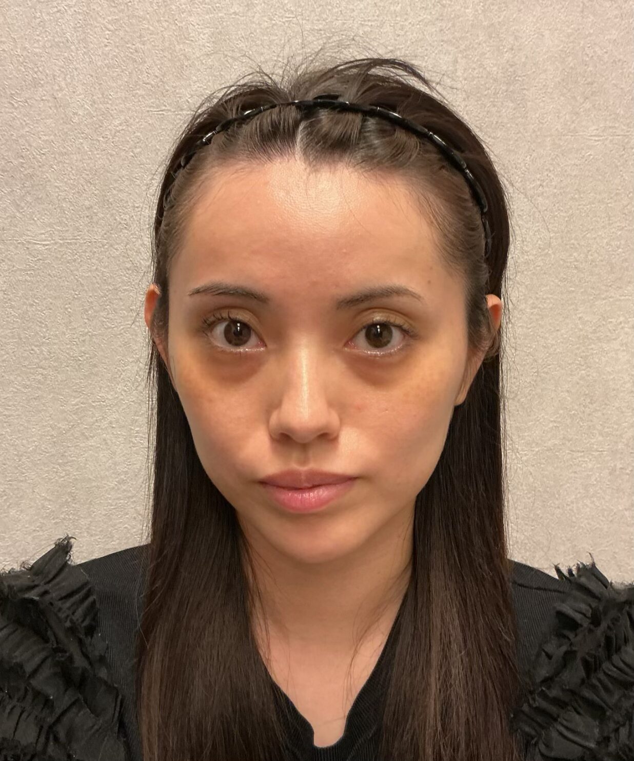 20代 女性 クマ・頬のこけ Before