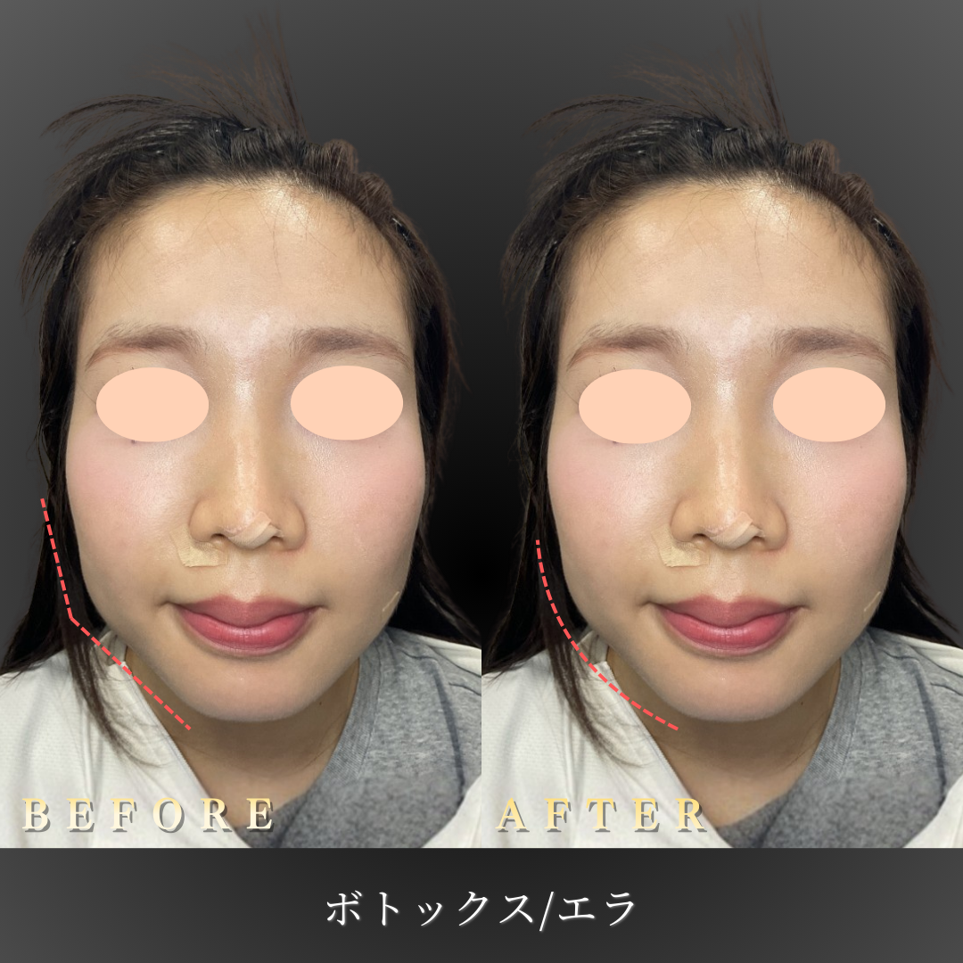 20代 エラボトックス 症例写真〔正面Before/After〕｜大阪 心斎橋BiBiクリニック