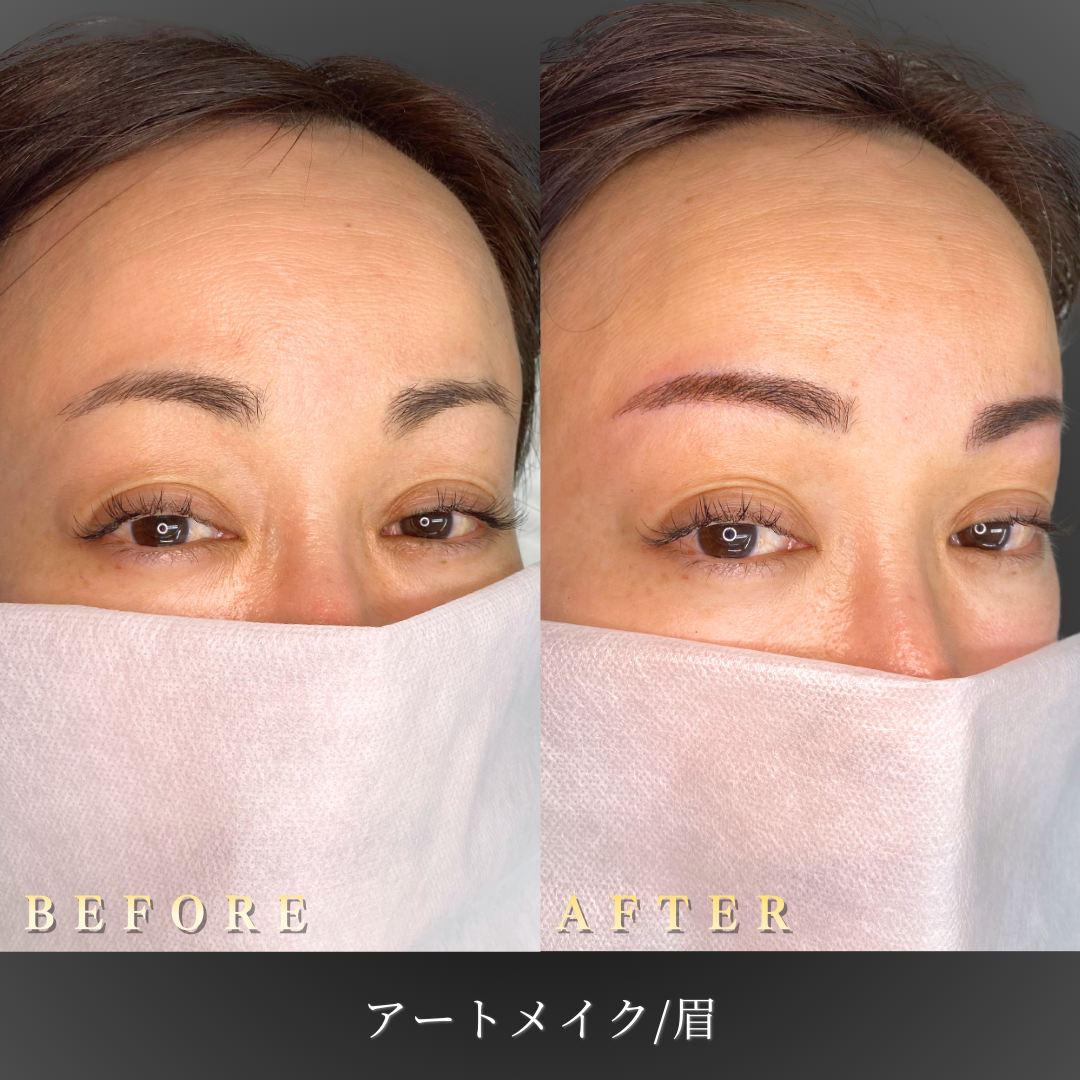 40代 眉アートメイク4D 症例写真〔右45度Before/After〕｜大阪 心斎橋BiBiクリニック