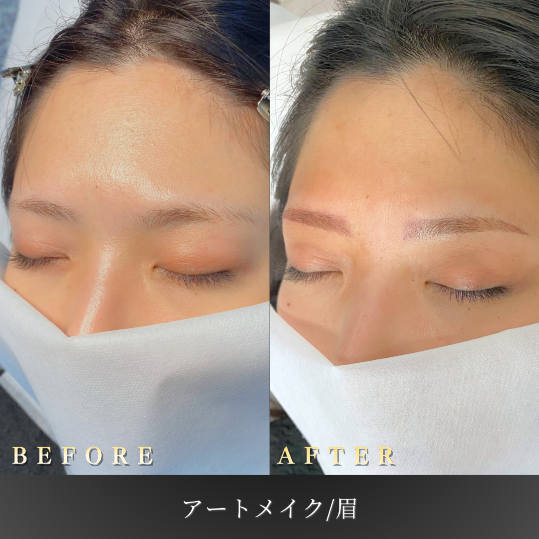 20代 眉アートメイク 症例写真〔右45度Before/After〕｜大阪 心斎橋BiBiクリニック