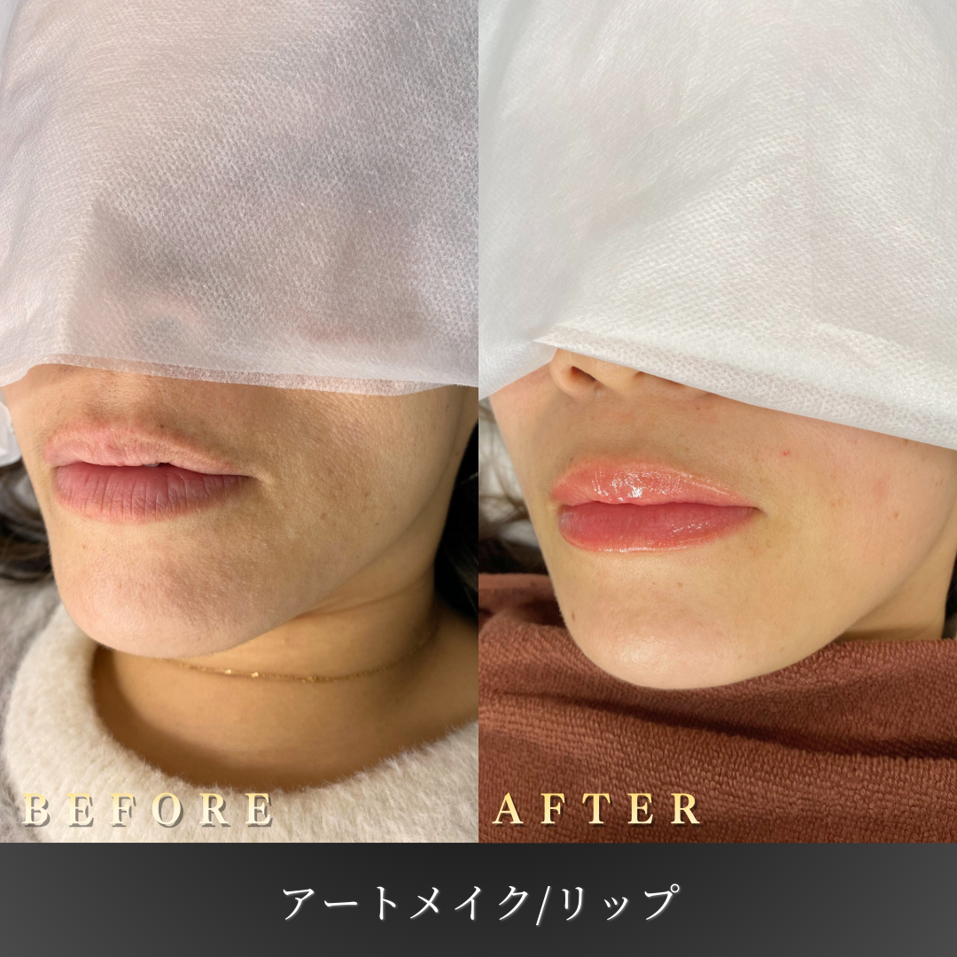40代 リップアートメイク 症例写真〔左45度Before/After〕｜大阪 心斎橋BiBiクリニック