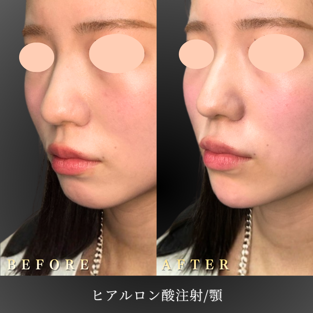20代女性 顎ヒアルロン酸 症例写真〔左45度Before/After〕｜大阪 心斎橋BiBiクリニック