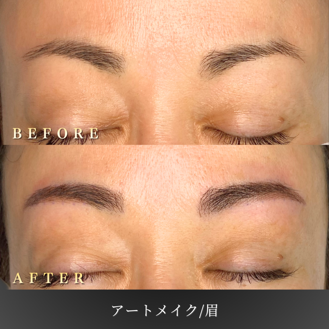 40代 眉アートメイク4D 症例写真〔正面Before/After〕｜大阪 心斎橋BiBiクリニック