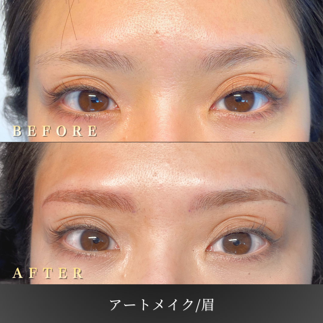 20代 眉アートメイク 症例写真〔右45度Before/After〕｜大阪 心斎橋BiBiクリニック