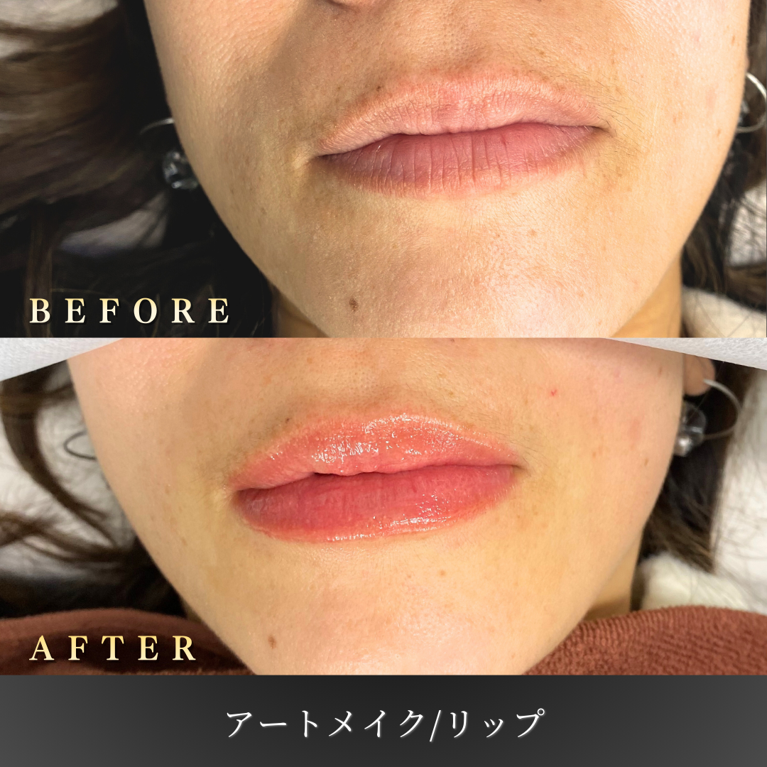 20代 リップアートメイク 症例写真〔正面Before/After〕｜大阪 心斎橋BiBiクリニック