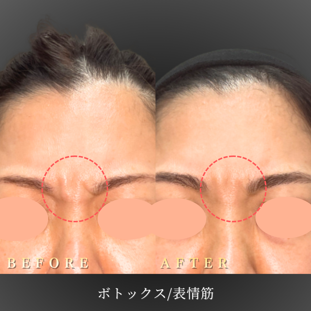 【40代女性】眉間と額を同時に整える表情筋ボトックス症例｜大阪 心斎橋BiBiクリニックの症例写真