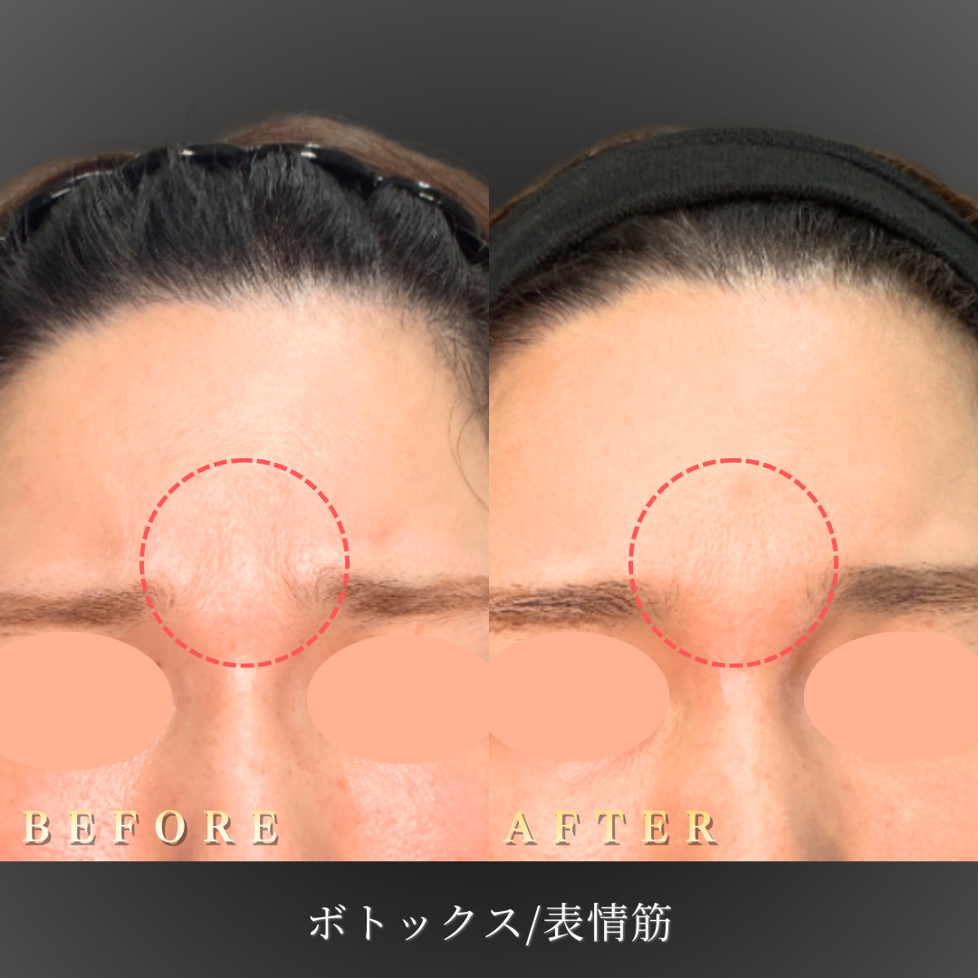 30代 表情筋ボトックス 症例写真〔Before/After〕｜大阪 心斎橋BiBiクリニック