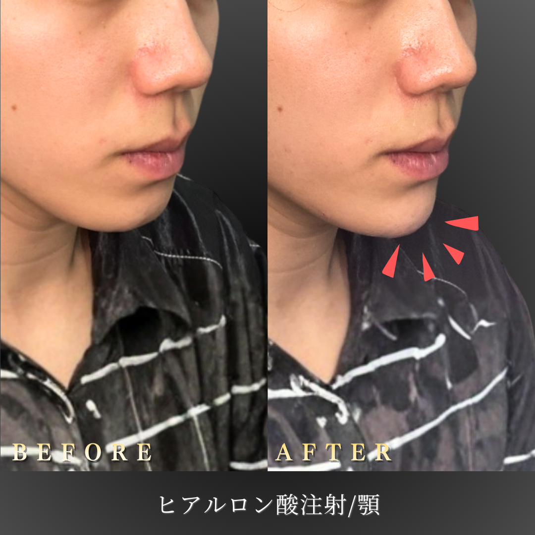 【20代男性】Eラインを整える顎ヒアルロン酸症例｜大阪 心斎橋BiBiクリニックの症例写真