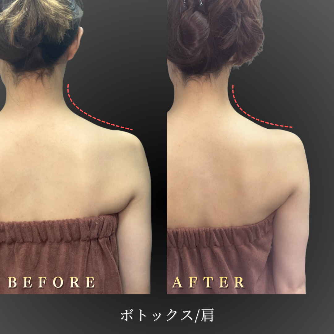 20代 肩ボトックス 症例写真〔背面Before/After〕｜大阪 心斎橋BiBiクリニック