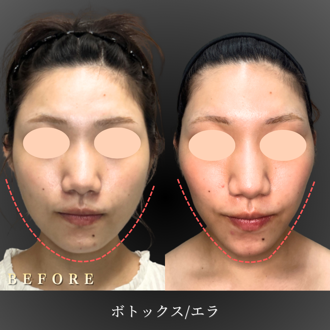 20代 エラボトックス 症例写真〔正面Before/After〕｜大阪 心斎橋BiBiクリニック