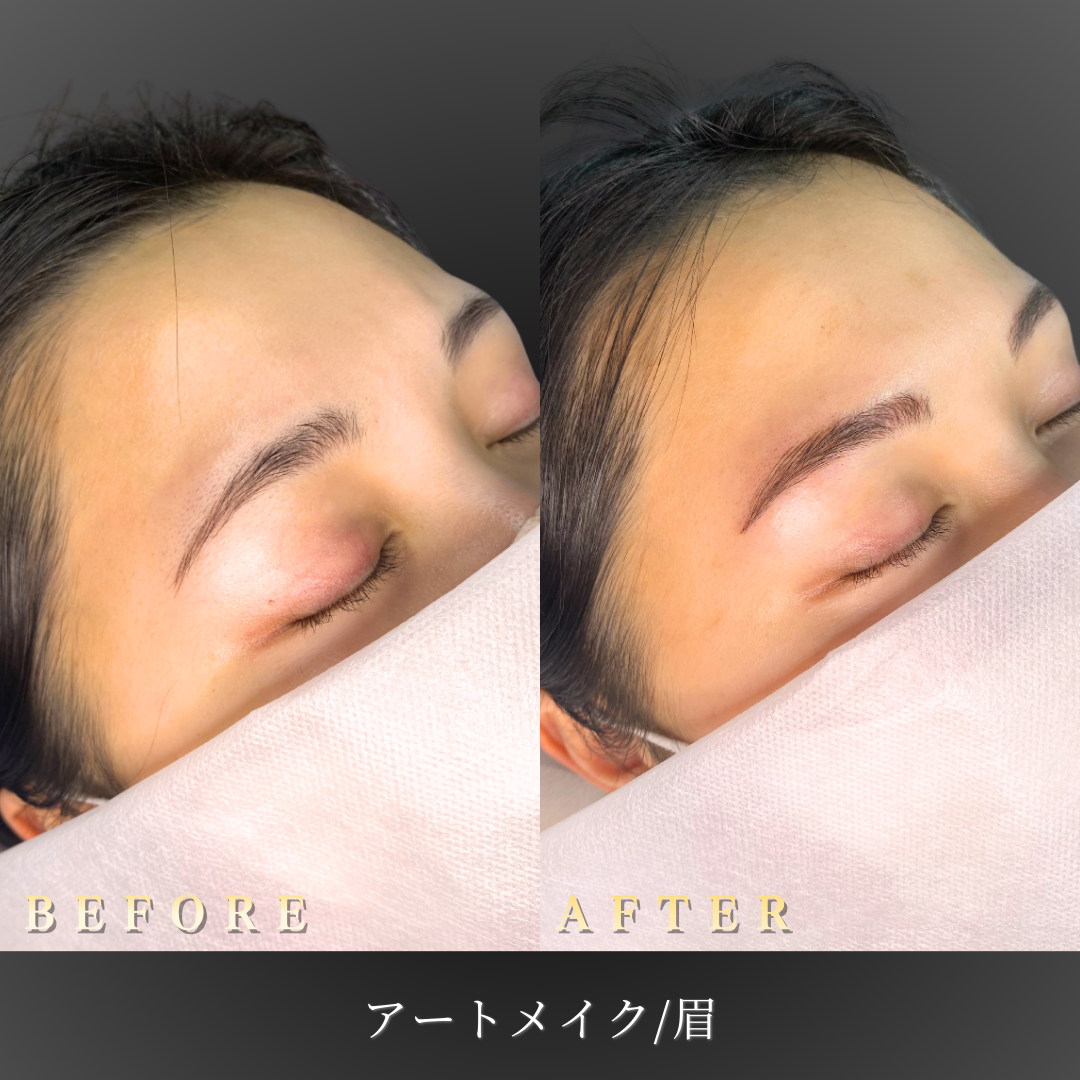 20代 眉アートメイク 症例写真〔右45度Before/After〕｜大阪 心斎橋BiBiクリニック