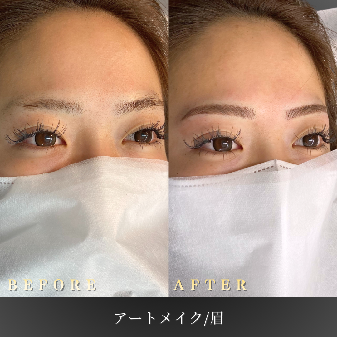 20代 眉アートメイク4D 症例写真〔右45度Before/After〕｜大阪 心斎橋BiBiクリニック