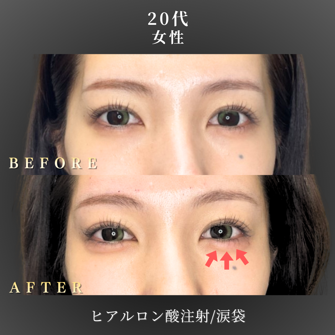 20代 ヒアルロン酸 症例写真〔正面B/A〕｜大阪 心斎橋BiBiクリニック