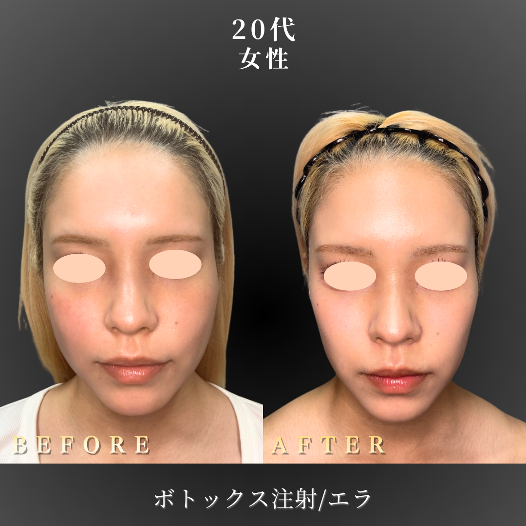 20代 エラボトックス 症例写真〔正面B/A〕｜大阪 心斎橋BiBiクリニック