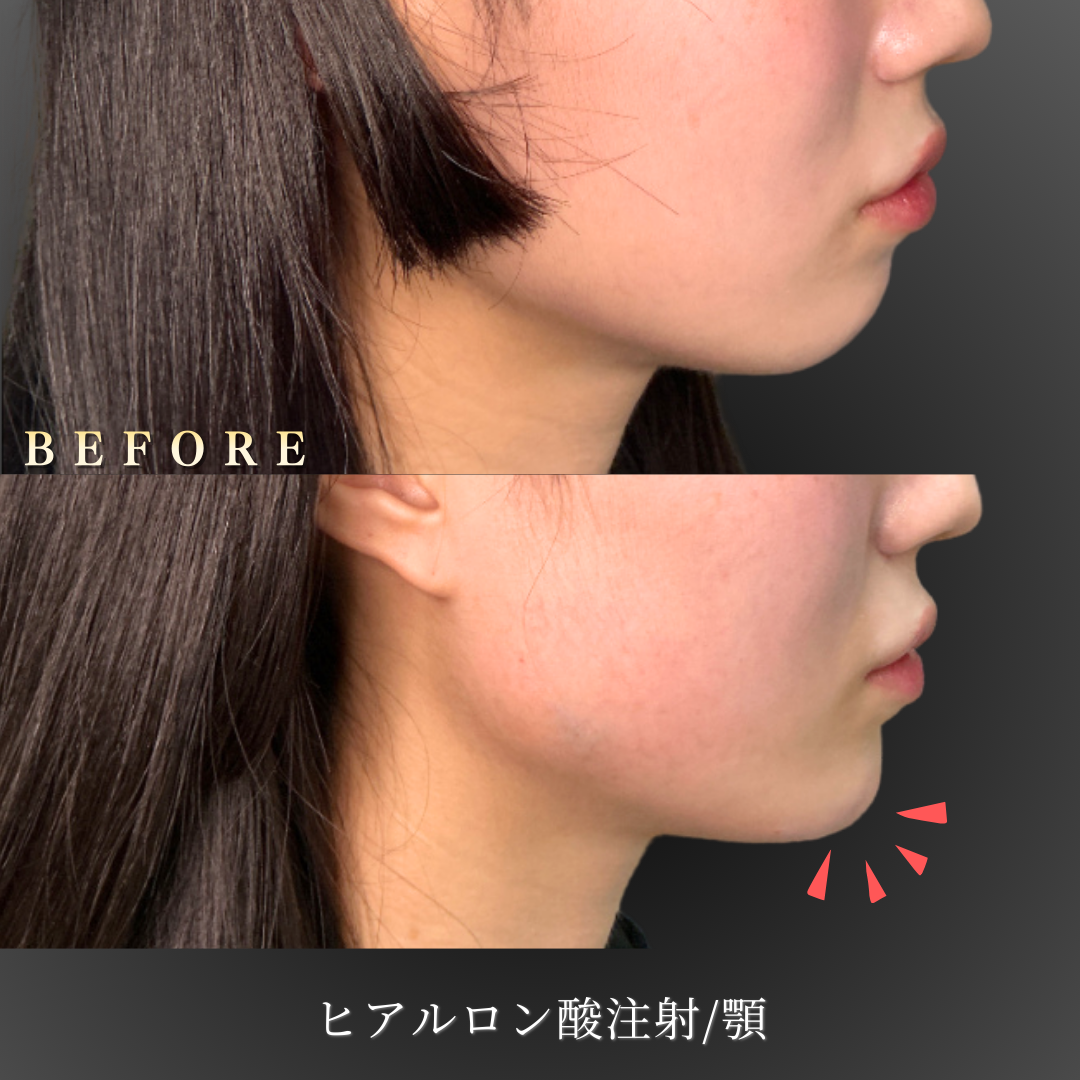 【20代女性】顎が小さく幼く見える方の顎ヒアルロン酸症例｜大阪 心斎橋BiBiクリニックの症例写真