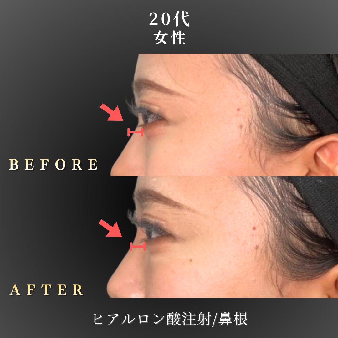 20代 ヒアルロン酸 症例写真〔左横 B/A〕｜大阪 心斎橋BiBiクリニック