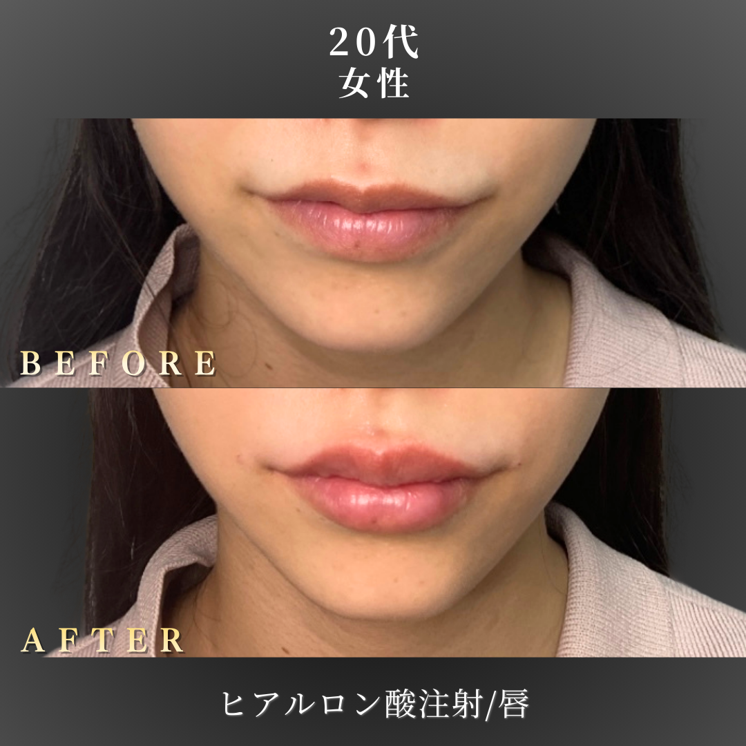 20代 ヒアルロン酸 症例写真〔正面B/A〕｜大阪 心斎橋BiBiクリニック