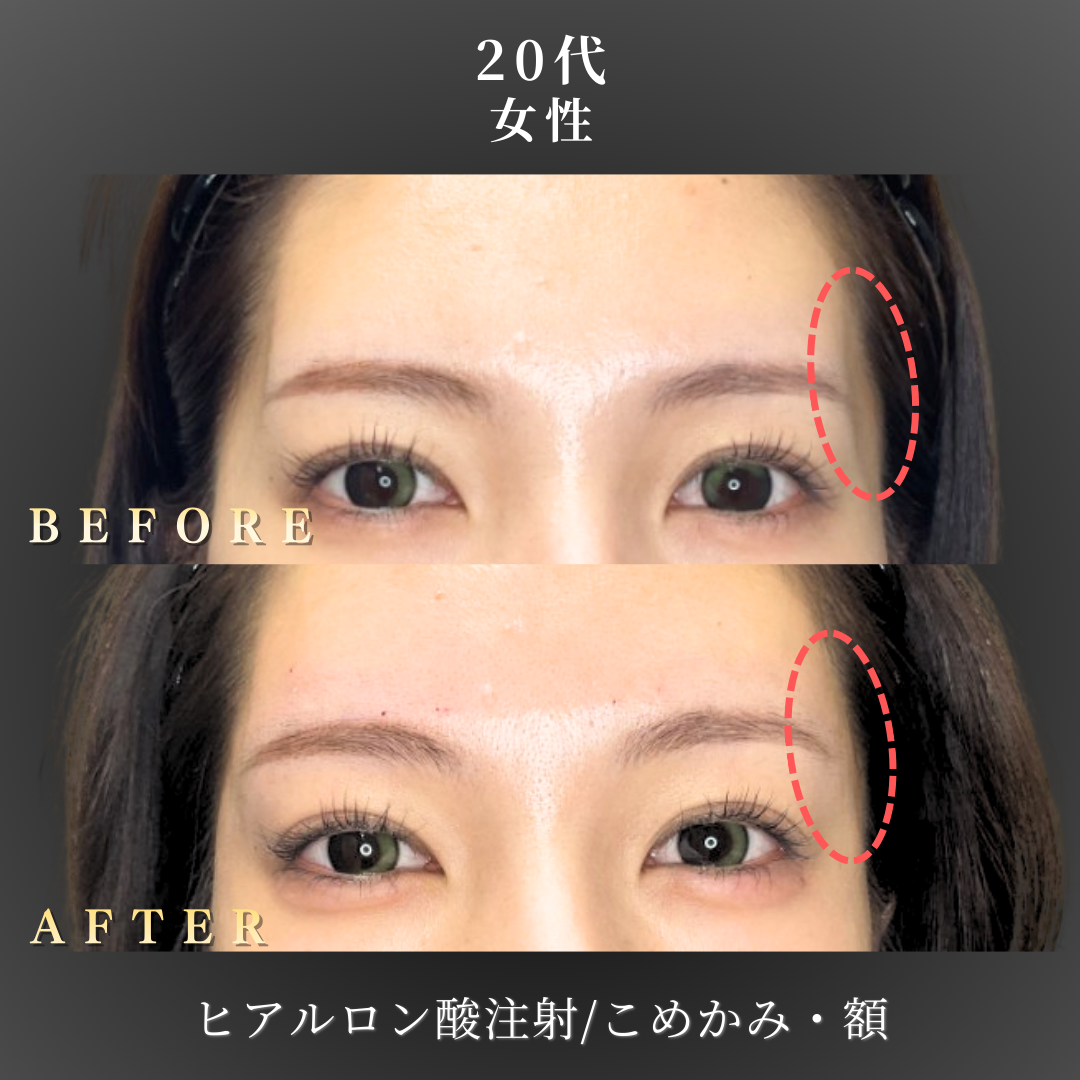 20代 ヒアルロン酸 症例写真〔正面B/A〕｜大阪 心斎橋BiBiクリニック