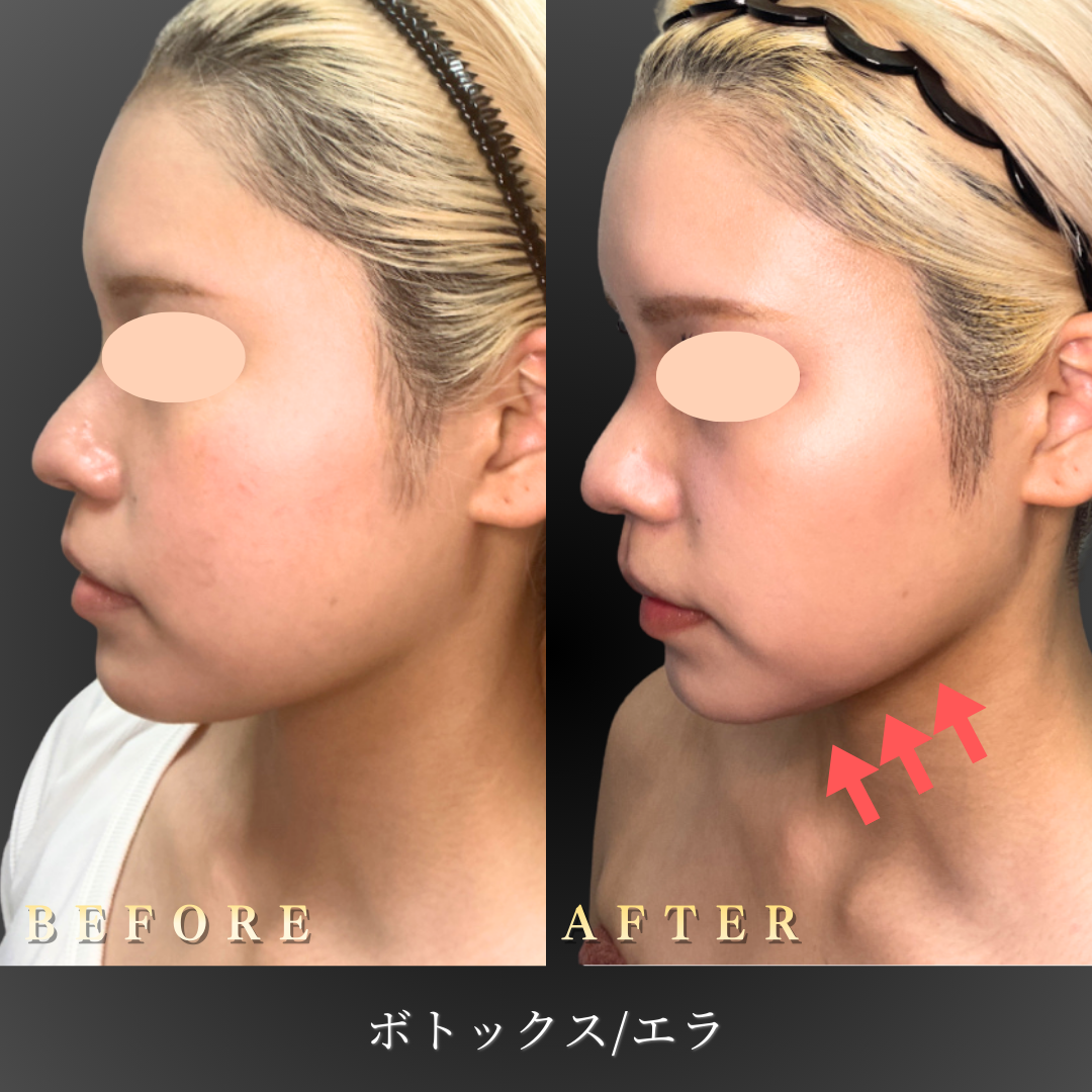 【サブ】20代 エラボトックス 症例写真〔左横Before/After〕｜大阪 心斎橋BiBiクリニック