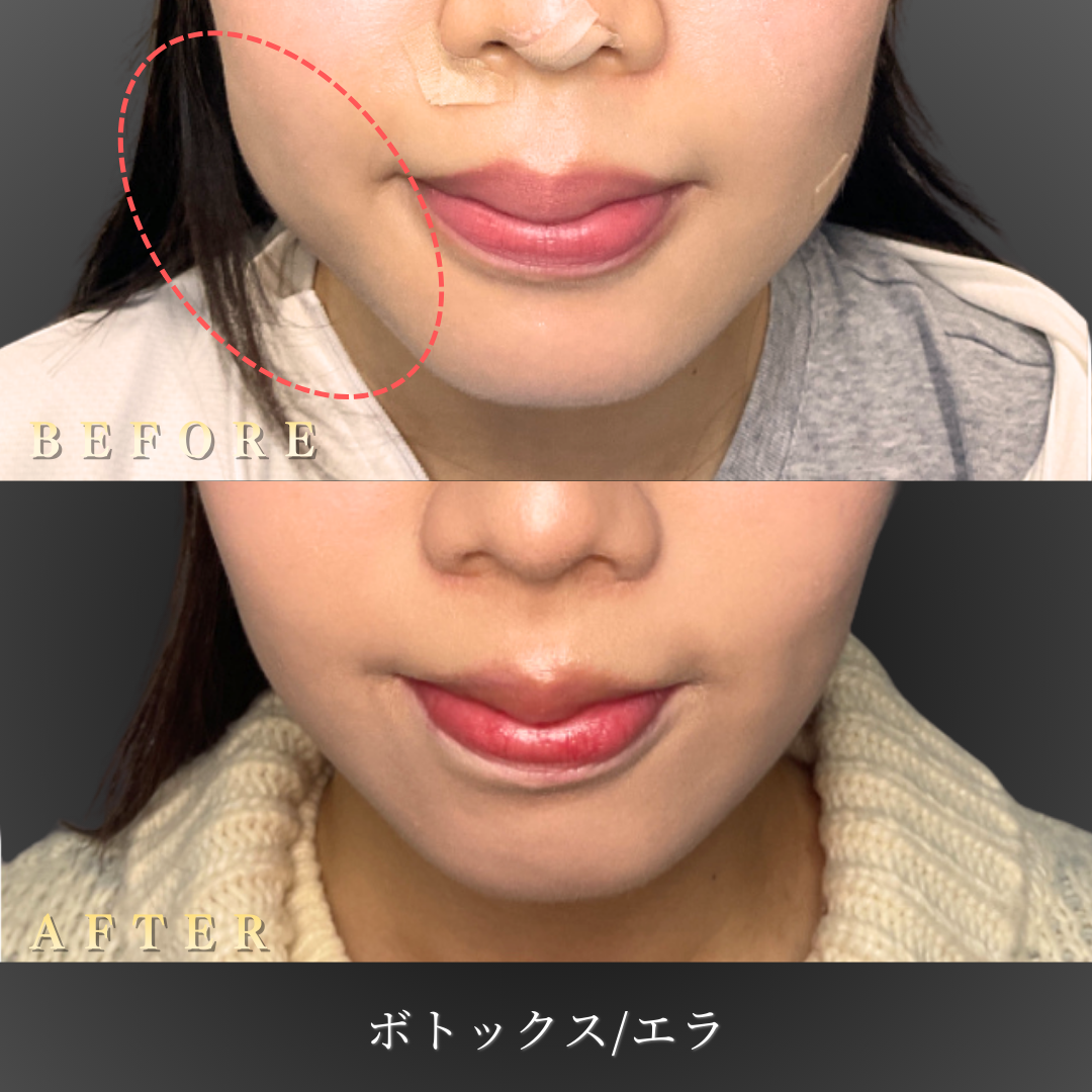 20代 エラボトックス 症例写真〔正面Before/After〕｜大阪 心斎橋BiBiクリニック
