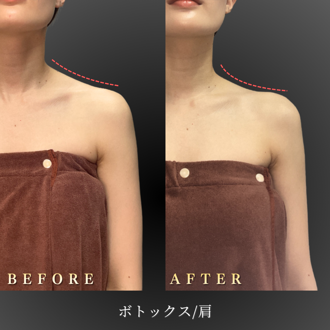 20代 肩ボトックス 症例写真〔正面Before/After〕｜大阪 心斎橋BiBiクリニック