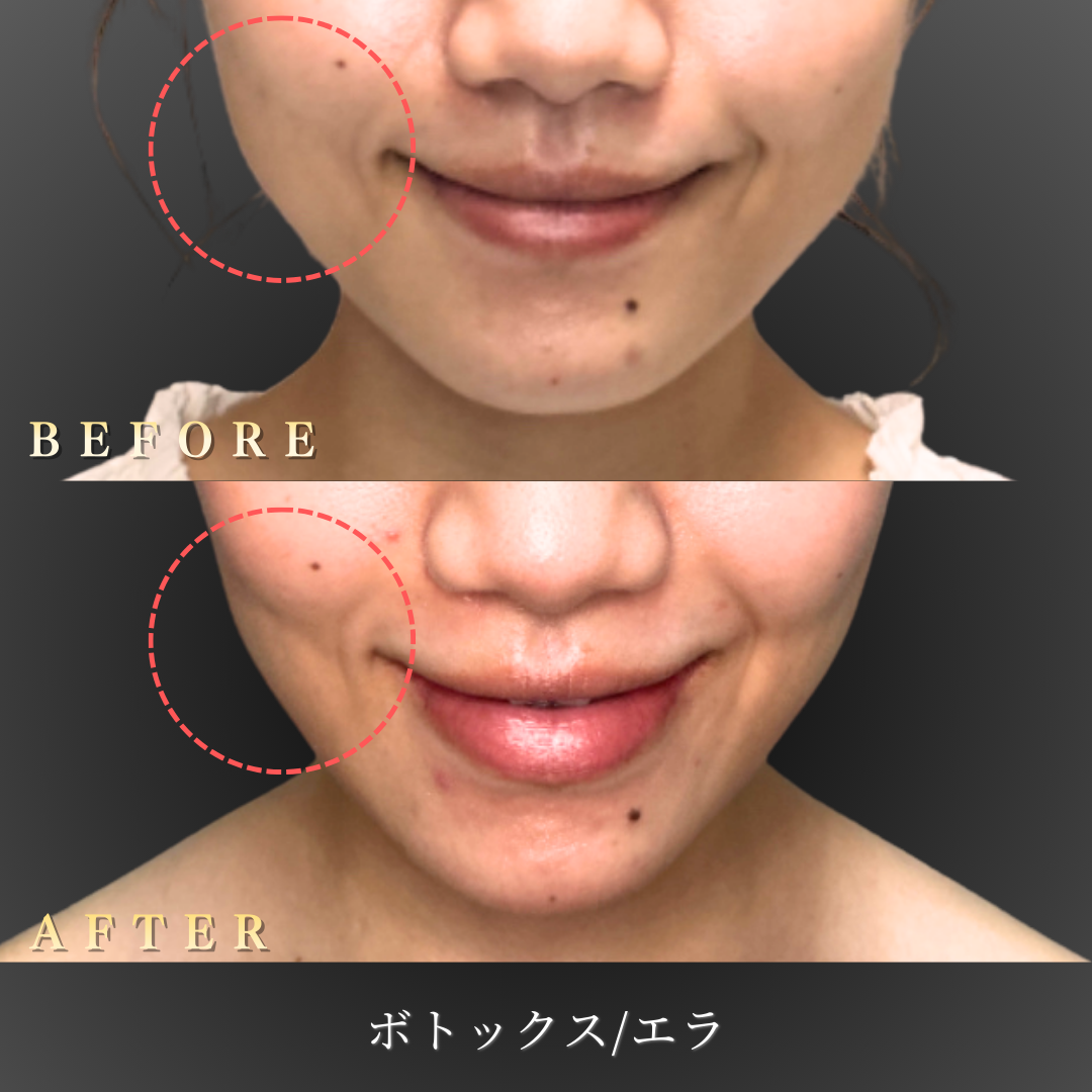 20代 エラボトックス 症例写真〔正面笑顔Before/After〕｜大阪 心斎橋BiBiクリニック