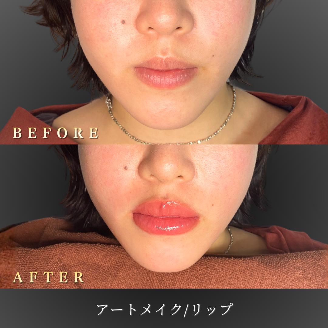 20代 リップアートメイク 症例写真〔正面Before/After〕｜大阪 心斎橋BiBiクリニック