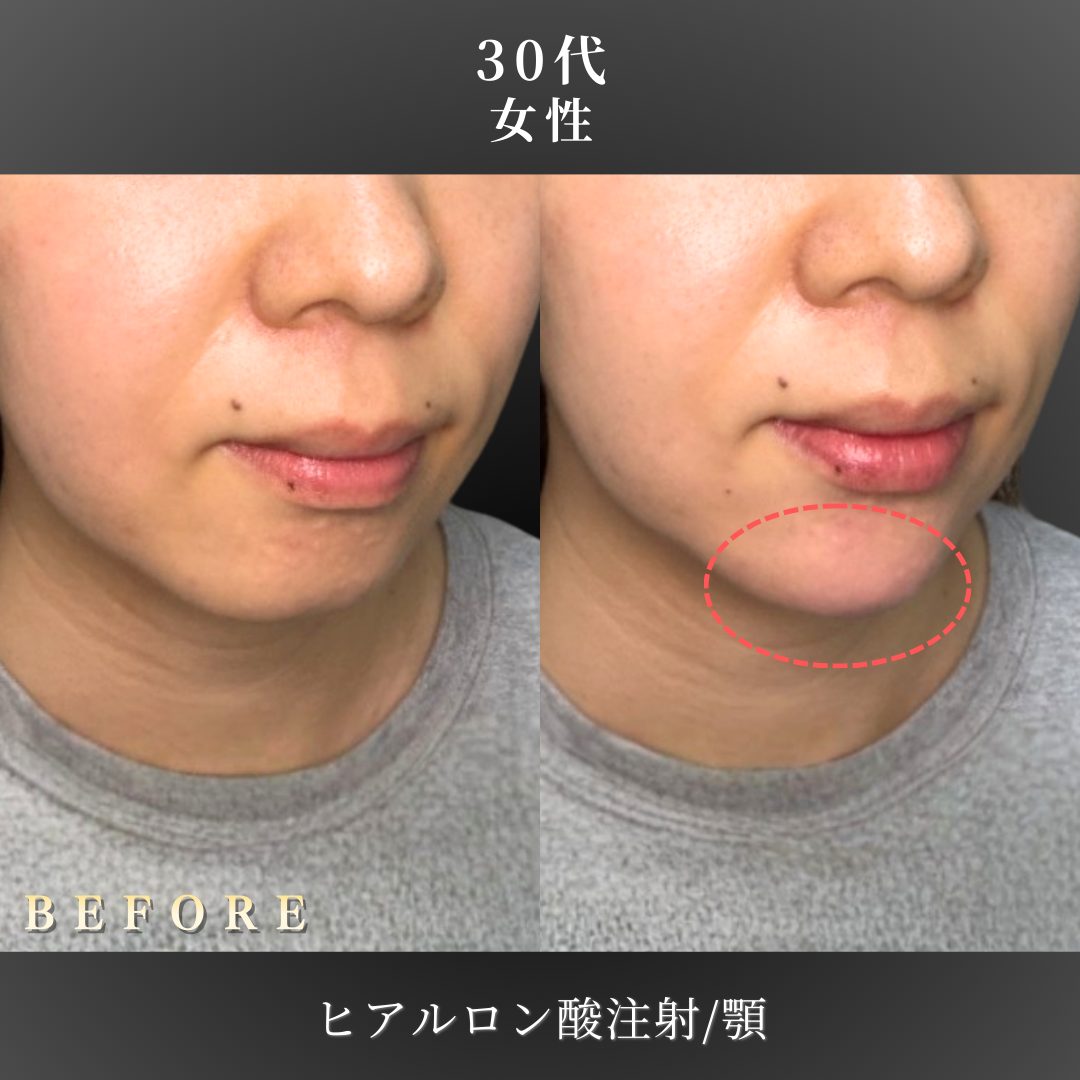 30代 顎ヒアルロン酸 症例写真〔右斜めB/A〕｜大阪 心斎橋BiBiクリニック