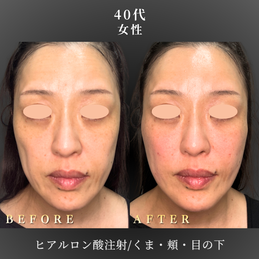 40代 ヒアルロン酸 症例写真〔正面B/A〕｜大阪 心斎橋BiBiクリニック
