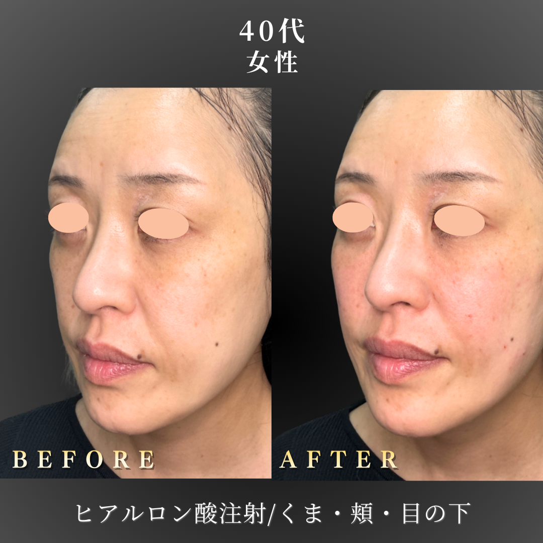 40代 ヒアルロン酸 症例写真〔左斜めB/A〕｜大阪 心斎橋BiBiクリニック