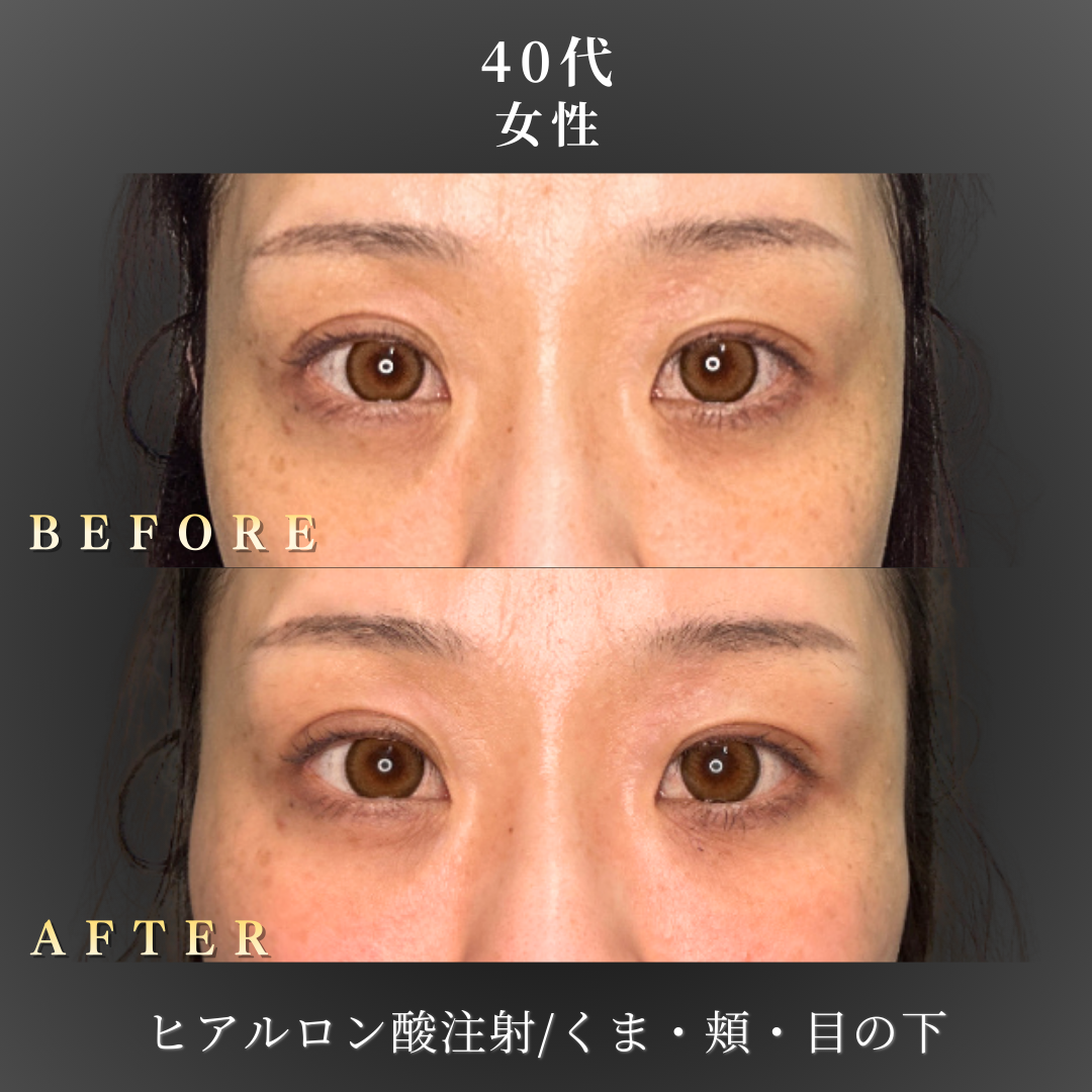 40代 ヒアルロン酸 症例写真〔正面B/A〕｜大阪 心斎橋BiBiクリニック