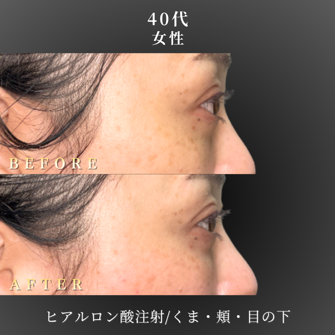40代 ヒアルロン酸 症例写真〔右横B/A〕｜大阪 心斎橋BiBiクリニック