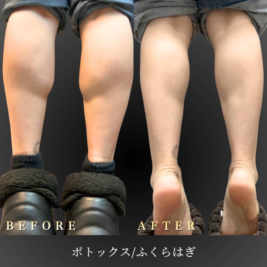 20代 ふくらはぎボトックス 症例写真〔背面Before/After〕｜大阪 心斎橋BiBiクリニック