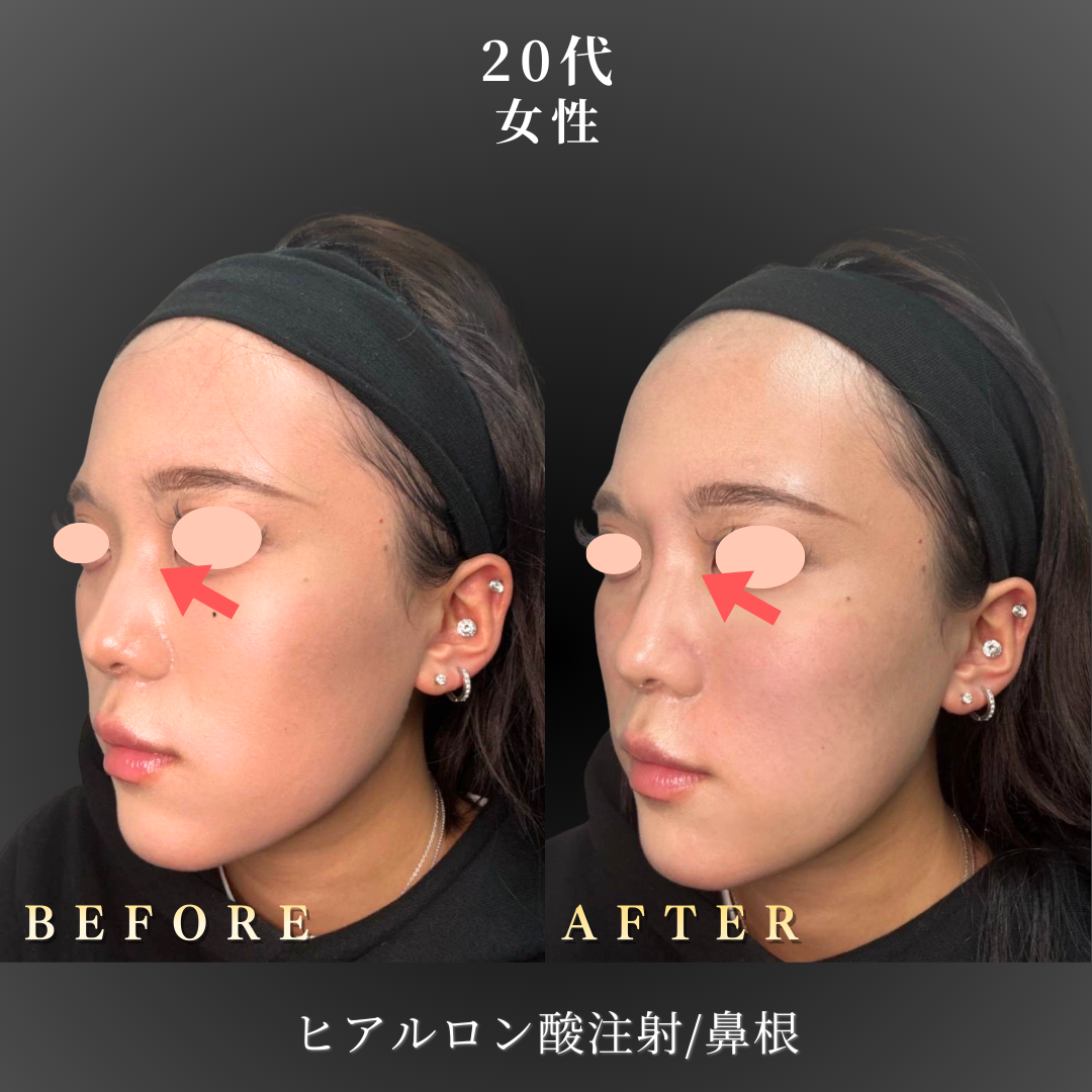 20代 ヒアルロン酸 症例写真〔左斜め B/A〕｜大阪 心斎橋BiBiクリニック