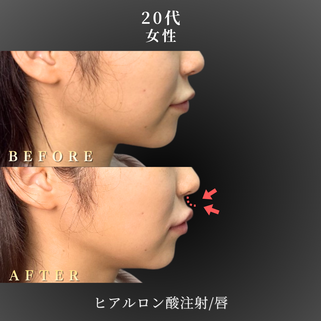 20代 ヒアルロン酸 症例写真〔右横B/A〕｜大阪 心斎橋BiBiクリニック